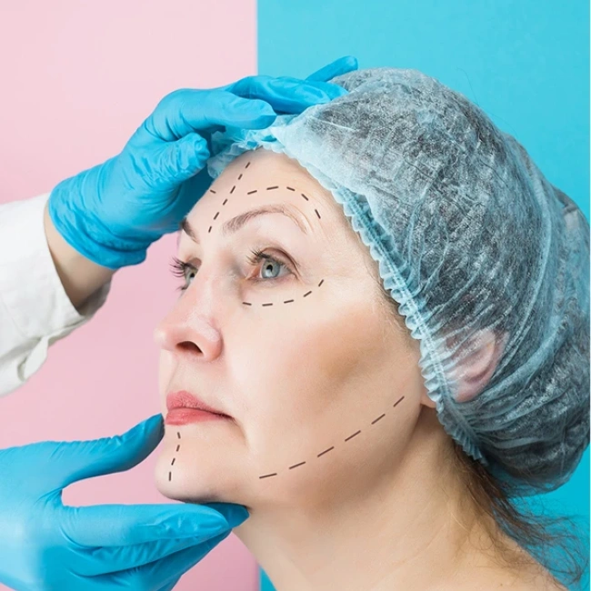 Otoplastia
